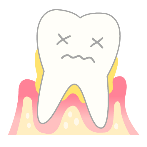 歯周病/予防歯科
